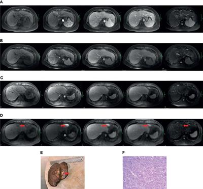 An MRI-Based Radiomic Model for Individualized Prediction of Hepatocellular Carcinoma in Patients With Hepatitis B Virus-Related Cirrhosis